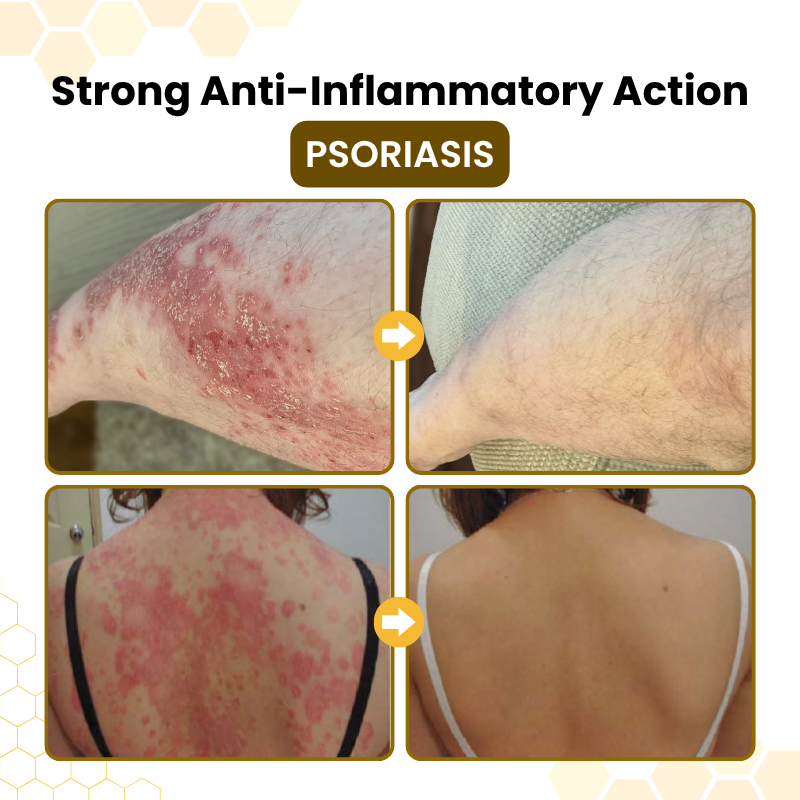 Timilk® PsoriaSoothe Bee Venom Skin-Restoration Cream🔥