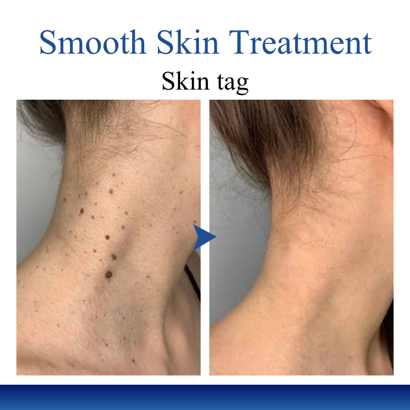 Timilk® DermiPoint Dual-Action Hydrocolloid Microneedle Patch